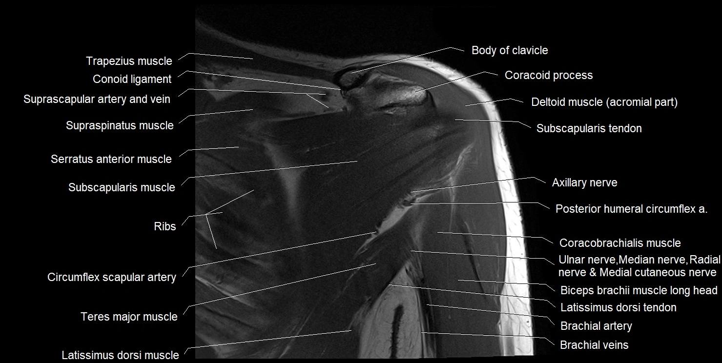 mri shoulder coronal cross sectional anatomy image 6.webp